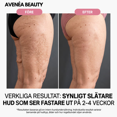 Före och efter – lår, synligt slätare hud på 2–4 veckor