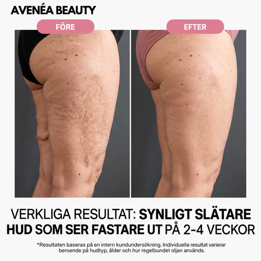Före och efter – lår, synligt slätare hud på 2–4 veckor